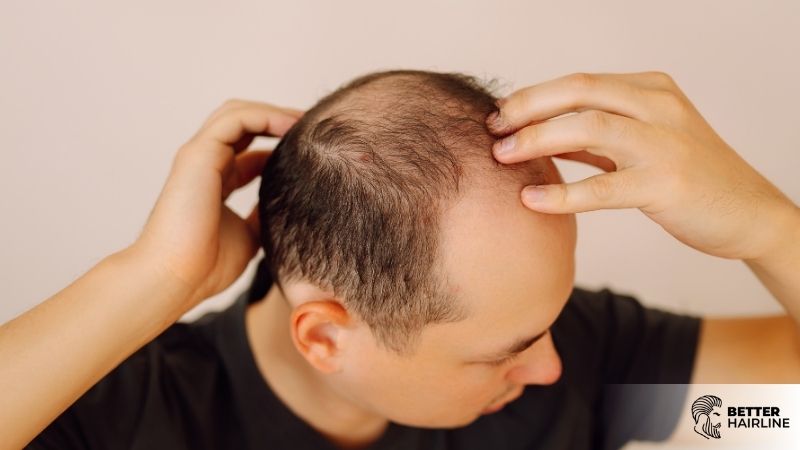 What Nobody Tells You About Shock Loss After a Hair Transplant