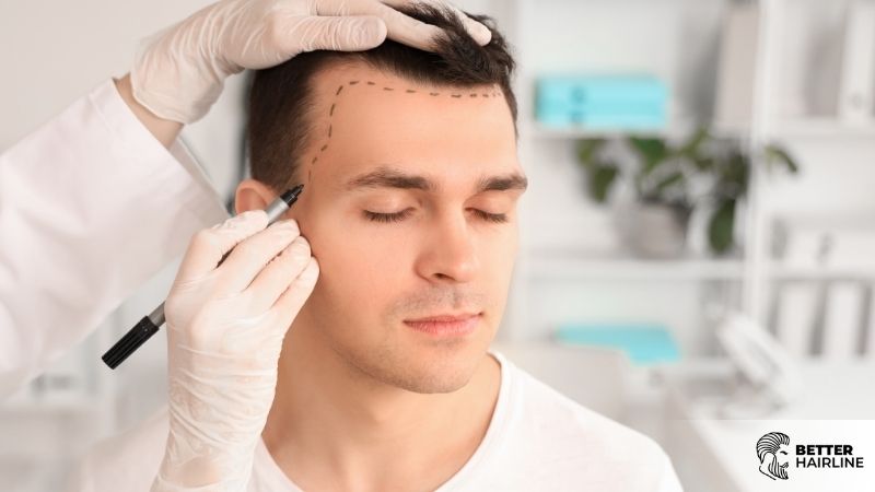 Hairline Design: What Actually Makes a Hair Transplant Look Natural