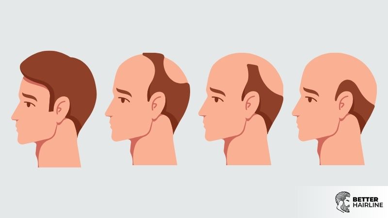 The Norwood Scale Explained: How to Identify Your Stage of Hair Loss