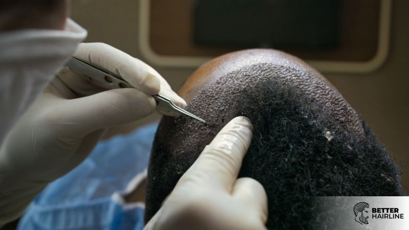 FUE vs. FUT: Which Hair Transplant Method Is Right for You?